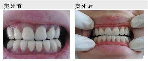 烤瓷牙修复的过程是怎样的呢