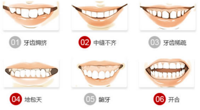 牙齿矫正的方法有哪些