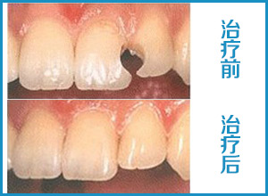 孩子牙齿上面有个洞怎么办