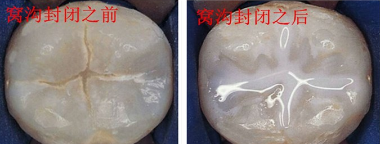 孩子做窝沟封闭有必要吗