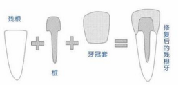  烤瓷牙一定要打桩吗