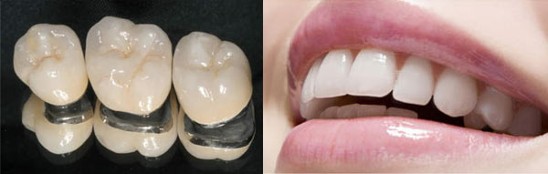 瓷贴面牙齿美白能保持多久?
