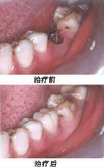 如何清洁种植牙基台