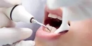 黄石上哪里洗牙
