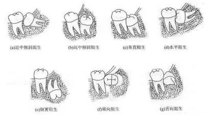 拔一颗智齿要多少钱