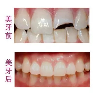 板牙掉了一半怎么办
